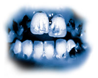 De giftige ingrediensene i meth medfører alvorlig tannråte, kjent som «meth-munn». Tennene blir svarte, flekkete og de råtner ofte i en slik grad at de må trekkes. Tennene og gommene ødelegges innenfra, og røttene råtner bort.